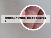 银屑病可以吃红腐乳吗 银屑病能不能吃豆腐乳