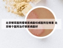 北京哪家医院看银屑病最权威医院在哪里 北京哪个医院治疗银屑病最好