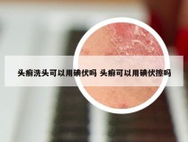 头癣洗头可以用碘伏吗 头癣可以用碘伏擦吗