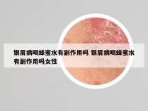 银屑病喝蜂蜜水有副作用吗 银屑病喝蜂蜜水有副作用吗女性