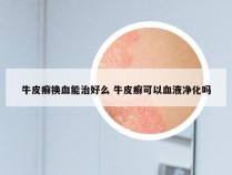 牛皮癣换血能治好么 牛皮癣可以血液净化吗