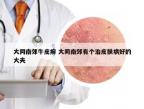 大同南郊牛皮癣 大同南郊有个治皮肤病好的大夫