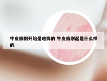 牛皮癣刚开始是啥样的 牛皮癣刚起是什么样的