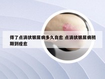 得了点滴状银屑病多久自愈 点滴状银屑病初期到痊愈
