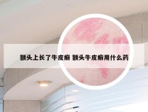额头上长了牛皮癣 额头牛皮癣用什么药