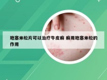地塞米松片可以治疗牛皮癣 癣用地塞米松的作用