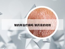 铍的邦治疗癣吗 铍药膏的功效