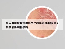 男人有银屑病现在怀孕了孩子可以要吗 男人银屑病影响怀孕吗