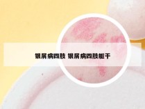 银屑病四肢 银屑病四肢躯干