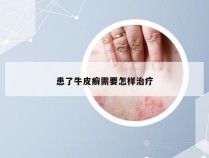 患了牛皮癣需要怎样治疗