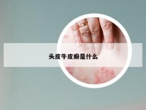 头皮牛皮癣是什么