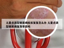 儿童点滴型银屑病反反复复怎么办 儿童点滴型银屑病复发率高吗