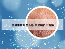 口臭牛皮癣怎么办 牛皮癣口干舌燥