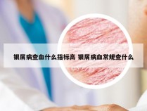银屑病查血什么指标高 银屑病血常规查什么