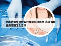 点滴状银屑病什么时候能到消退期 点滴状银屑病后期怎么治疗