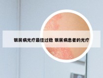 银屑病光疗最佳过稳 银屑病患者的光疗