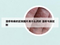 湿疹和癣的区别图片用什么药好 湿疹与藓区别