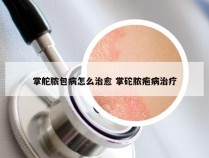 掌舵脓包病怎么治愈 掌砣脓疱病治疗