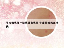 牛皮癣头部一洗头就有头屑 牛皮头癣怎么洗头