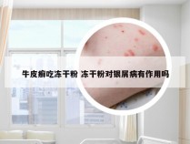牛皮癣吃冻干粉 冻干粉对银屑病有作用吗