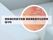 银屑病吃转因子胶囊 银屑病患者可以吃转移因子吗