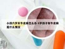 小孩六岁长牛皮癣怎么办 6岁孩子有牛皮癣是什么情况