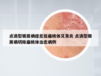 点滴型银屑病痊愈后扁桃体又发炎 点滴型银屑病切除扁桃体治愈病例