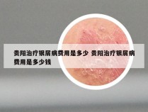 贵阳治疗银屑病费用是多少 贵阳治疗银屑病费用是多少钱