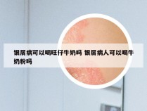银屑病可以喝旺仔牛奶吗 银屑病人可以喝牛奶粉吗