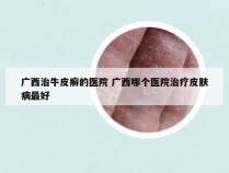 广西治牛皮癣的医院 广西哪个医院治疗皮肤病最好