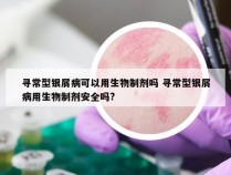寻常型银屑病可以用生物制剂吗 寻常型银屑病用生物制剂安全吗?