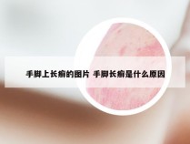 手脚上长癣的图片 手脚长癣是什么原因