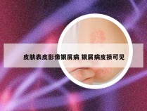 皮肤表皮影像银屑病 银屑病皮损可见