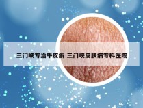 三门峡专治牛皮癣 三门峡皮肤病专科医院