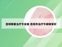 昆明哪里治疗牛皮癣 昆明市治疗牛癣哪家好