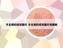 手足癣的症状图片 手足癣的症状图片和图解