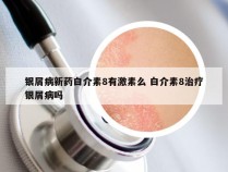 银屑病新药白介素8有激素么 白介素8治疗银屑病吗