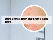 轻度银屑病引起的症状 轻度银屑病引起的症状表现