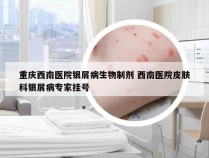 重庆西南医院银屑病生物制剂 西南医院皮肤科银屑病专家挂号