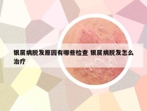 银屑病脱发原因有哪些检查 银屑病脱发怎么治疗
