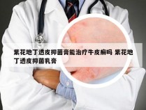 紫花地丁透皮抑菌膏能治疗牛皮癣吗 紫花地丁透皮抑菌乳膏