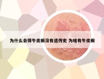 为什么会得牛皮癣没有遗传史 为啥有牛皮癣