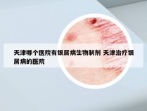 天津哪个医院有银屑病生物制剂 天津治疗银屑病的医院