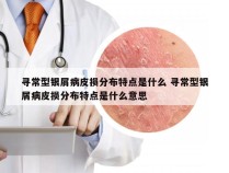 寻常型银屑病皮损分布特点是什么 寻常型银屑病皮损分布特点是什么意思