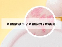 银屑病留疤好不了 银屑病治好了会留疤吗