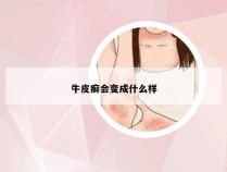 牛皮癣会变成什么样