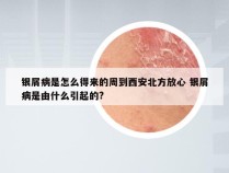银屑病是怎么得来的周到西安北方放心 银屑病是由什么引起的?