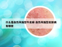 什么是血热风燥型牛皮癣 血热风燥型皮肤病有哪些