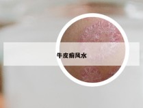 牛皮癣风水