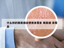 什么样的银屑病会使用青霉素 银屑病 青霉素